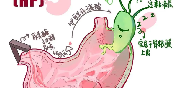 【必看】幽門(mén)螺桿菌真相揭示，別再忽視你的胃痛了！